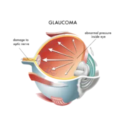 Glaucoma, a day dedicated to raising awareness about this silent eye disease, which can cause irreversible blindness if not identified and treated in time. 
Glaucoma occurs due to increased intraocular pressure, which leads to degeneration of the optic nerve and progressive loss of vision. Since the condition develops asymptomatically in the early stages, many people only notice the disease in advanced stages, when visual damage is already significant. 
This date is part of World Glaucoma Week, promoted by health institutions in several countries. The campaigns seek to raise awareness about the importance of regular eye exams, especially for risk groups, which include people over 40, diabetics, hypertensive patients and individuals with a family history of the disease. 
Treatment of glaucoma may involve eye drops, oral medications, laser or surgery, depending on the severity of the condition. However, prevention and early diagnosis are essential to avoid permanent damage to vision and ensure quality of life for patients.