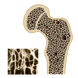 El 20 de octubre, Día de la Osteoporosis , tiene como objetivo concienciar s