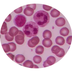 25 de outubro dia da Síndrome Mielodisplásica (SMD), é uma desordem da medul